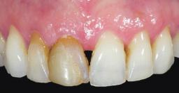 Immediate loading with prefabricated abutments and provisional crowns for optimal shape and