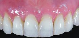 Alessandro Pozzi, Surgeon and Prosthodontist, Rome, Italy Final abutments Placement of two