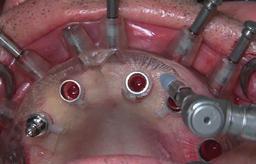 Although satisfied with the appearance of existing removable denture, the patient desired a fixed alter native to his troublesome upper denture.