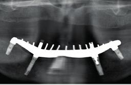 After guided drilling, six NobelReplace Conical Connection implants were placed using guided implant mounts.
