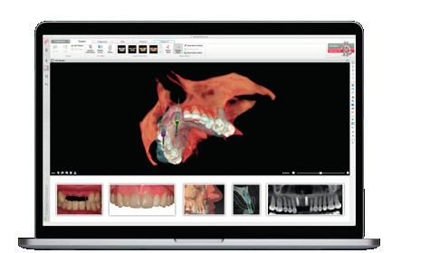 Nobel Biocare has always been at the forefront of digital dentistry, enhancing your choice of treatment strategies.