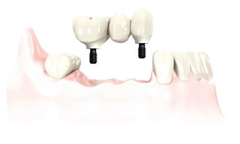 Achieve truly esthetic results Keep your patients new smile Give your patients the new smile they deserve.