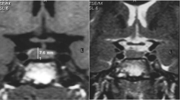 less and late enhancement relative to the normal pituitary gland. Signal intensity similar to CSF with loss of high signal on FLAIR was seen in epidermoid tumors.