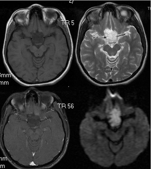 Pituitary stalk was not separately identi ed from the tumor in any of the macroadenomas (100%). Cappabianca et al.reported nonvisualization of the pituitary stalk in 15.2% of cases.