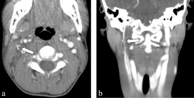 Elevated CRP and ESR Ultrasound or CT to evaluate internal