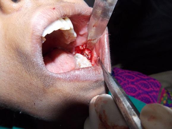 1,2,3 Worldwide, incidence has been estimated at 1.44 cysts for every 100 unerupted teeth.