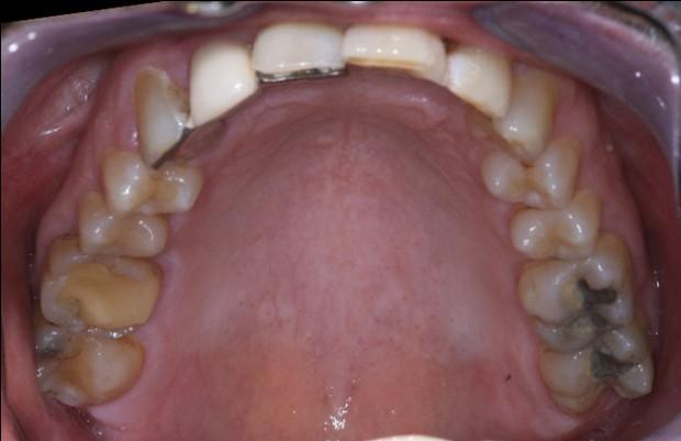 The periodontal status was consistent with early periodontitis as sulcus depths measured 1-5mm and