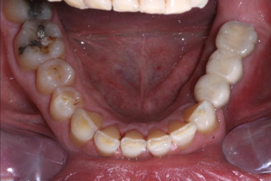 were not necessary, and the placement of the transmucosal healing collars at the time of implant placement eliminated the need for a second stage cutting procedure.