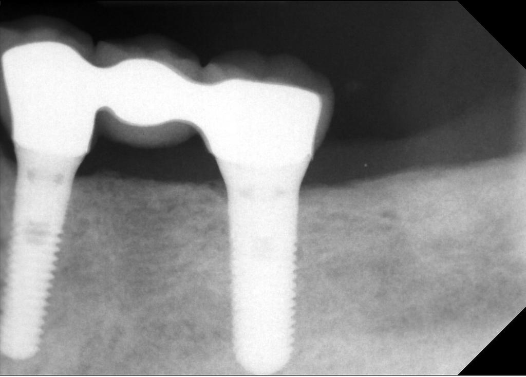 The implant was placed with the junction of the textured and polished surface just at the crest of bone, keeping the microgap of the implant-abutment connection 2mm supracrestal,