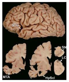 Hippocampal sclerosis in familial PD Greek-American kindred with A53T mutation in SNCA.