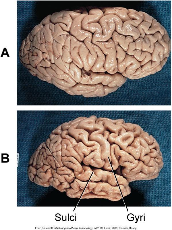 Alzheimer Disease A. Normal brain B.