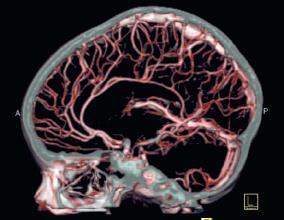 Cerebral Angiogram process of recording the