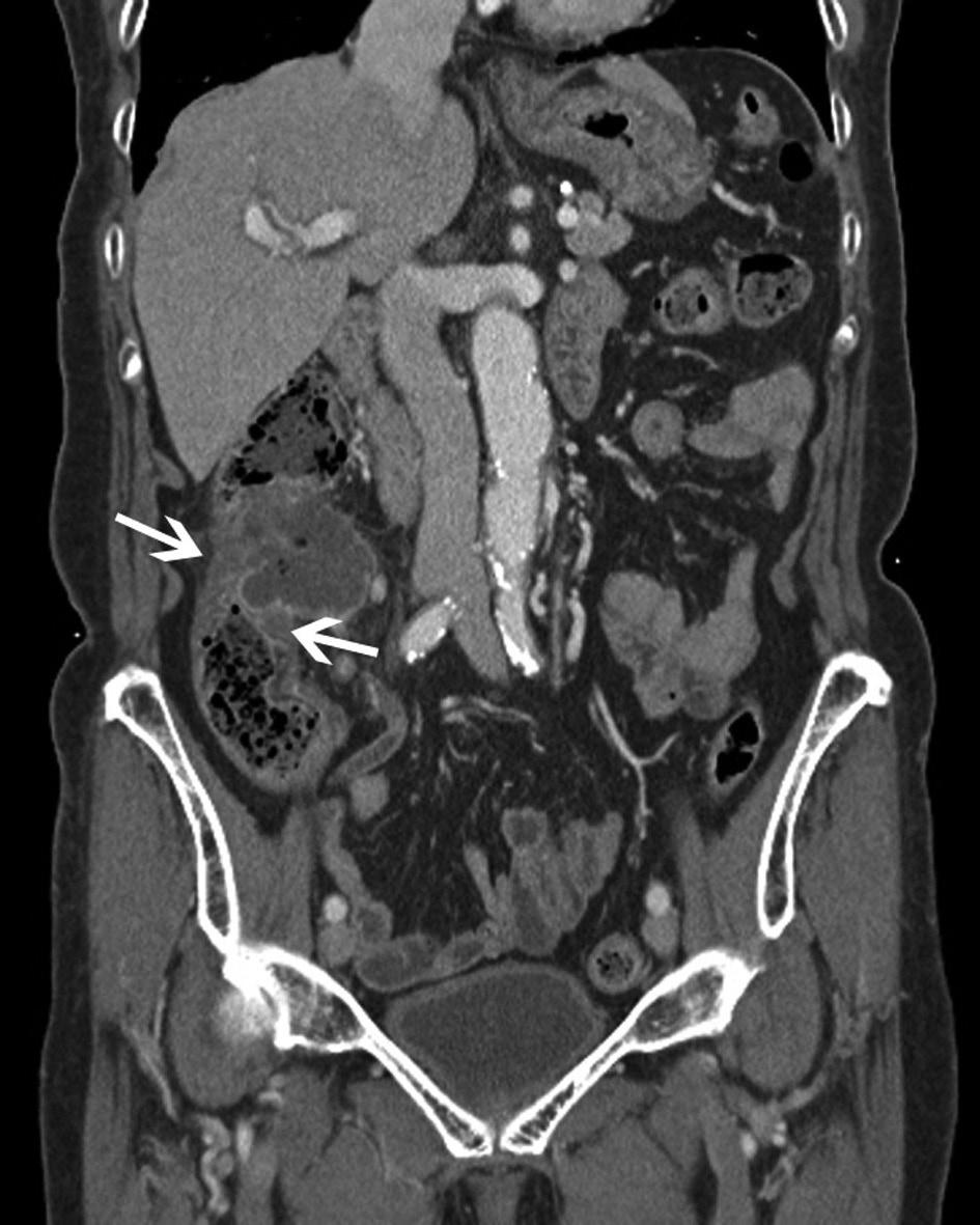 Goun Choi, et al fined, but contained a small amount of air (Fig. 1A, B). There traperitoneal free air was seen. The appendix and other pelvic was no calcification within the mass like lesion.