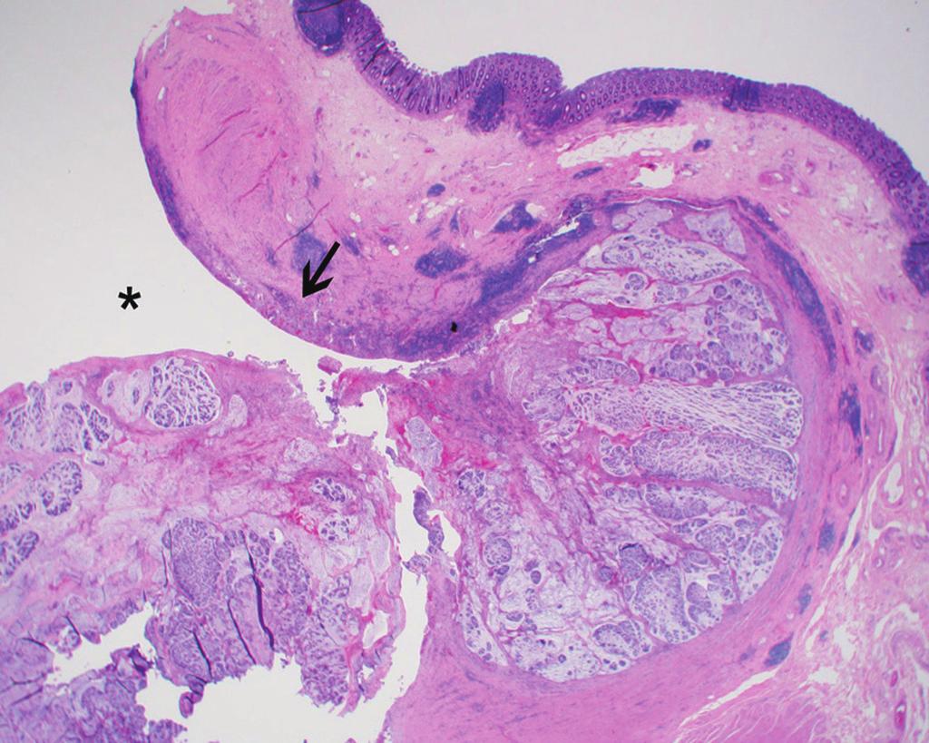 Mucinous Adenocarcinoma Arising within a Colonic Diverticulum E F Fig. 1. A 82-year-old female with a mucinous adenocarcinoma arising in ascending colonic diverticulum. E. The mucosa lining the diverticulum is eroded (arrow) along the diverticular opening (asterisk).