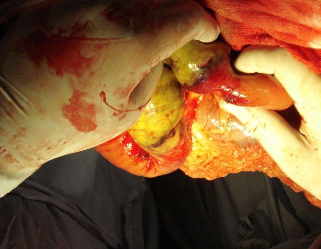 Intra-operatively, band adhesion with complete obstruction was found in 4 patients, 1 patient had resection of a part of the bowel because of strangulating gangrene of that part, at the site of band