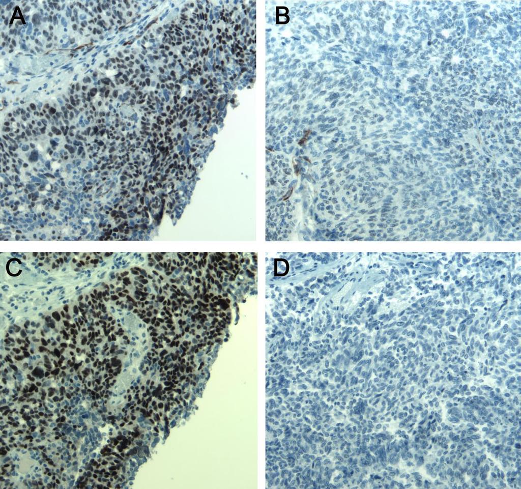 Results: Zonal pattern of staining WT-1 (A) and ER (C) staining at well fixed/ peripheral portions of the specimen versus WT-1 (B)