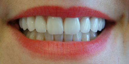 DENTISTRY. The A-Z of doing a Smile Makeover (8-10 units of porcelain restorations).
