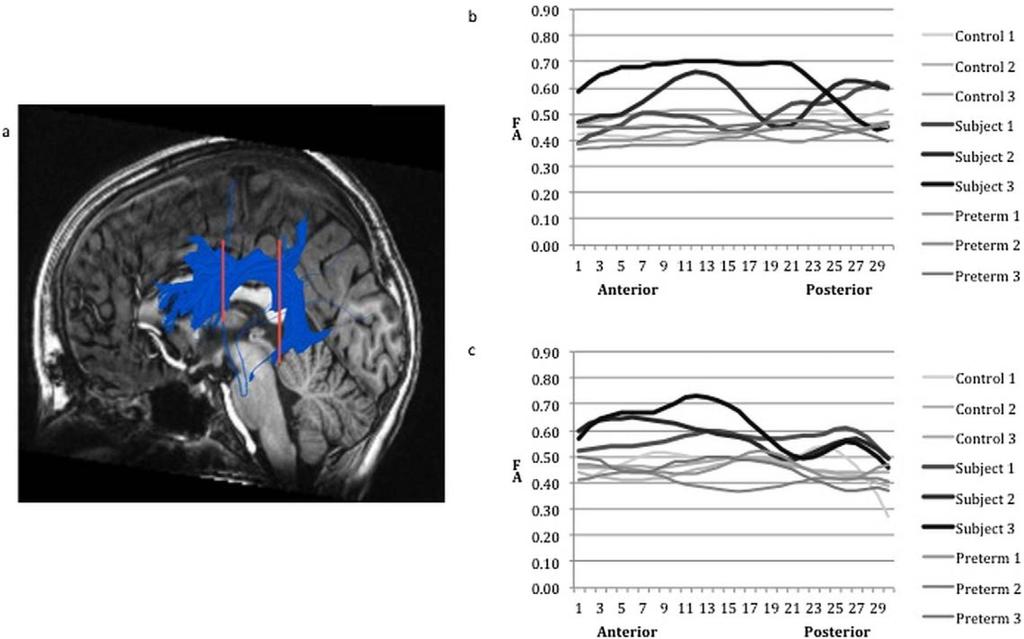 Myall et al. Page 7 Figure 1. (a) The superior longitudinal/arcuate fasciculus in a full-term control visualized with QUENCH.