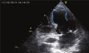 2 Case Reports in Cardiology (a) (b) (c) Figure 1: (a) Transthoracic echocardiogram (TTE) on admission, anterior and apical severe hypokinesia in both