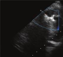 perforation (arrow) and a left ventricular ejection fraction of 41% (video); (c) TTE previous to discharge with the Amplatzer device and an improved left