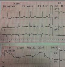(a) (b) Figure 2: (a) Baseline EKG with no significant changes; (b) EKG with negative T waves in all precordial leads.