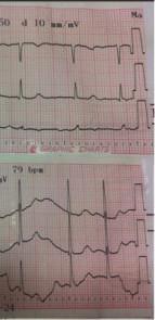 ballooningpattern(figures1and3)andaleftventricular ejection fraction of 41%.