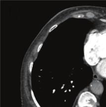 Case Reports in Cardiology 3 Figure 3: CT angiography showing the