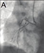 (a) (b) (c) (d) (e) (f) Figure 4: Coronary angiography describing