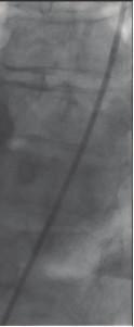 (a) Small right coronary artery with an intermediate lesion in an acute