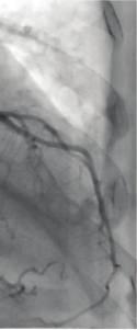 ((e) and (f)) Left ventricular angiogram with the anterior and apical