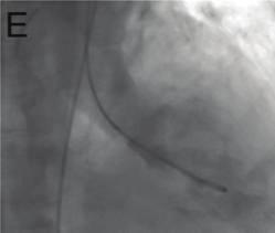 1(b)). A coronary angiography was performed to assess the coronary tree.