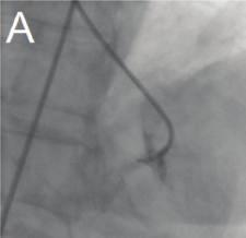 4 Case Reports in Cardiology (a) (b) (c) (d) (e) (f) Figure 5: (a) Catheterization of the left ventricle and the ventricular