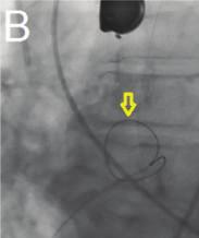 and the snore in the right atrium (arrow); ((d) and (e)) Amplatzer device previous implantation through the right to left