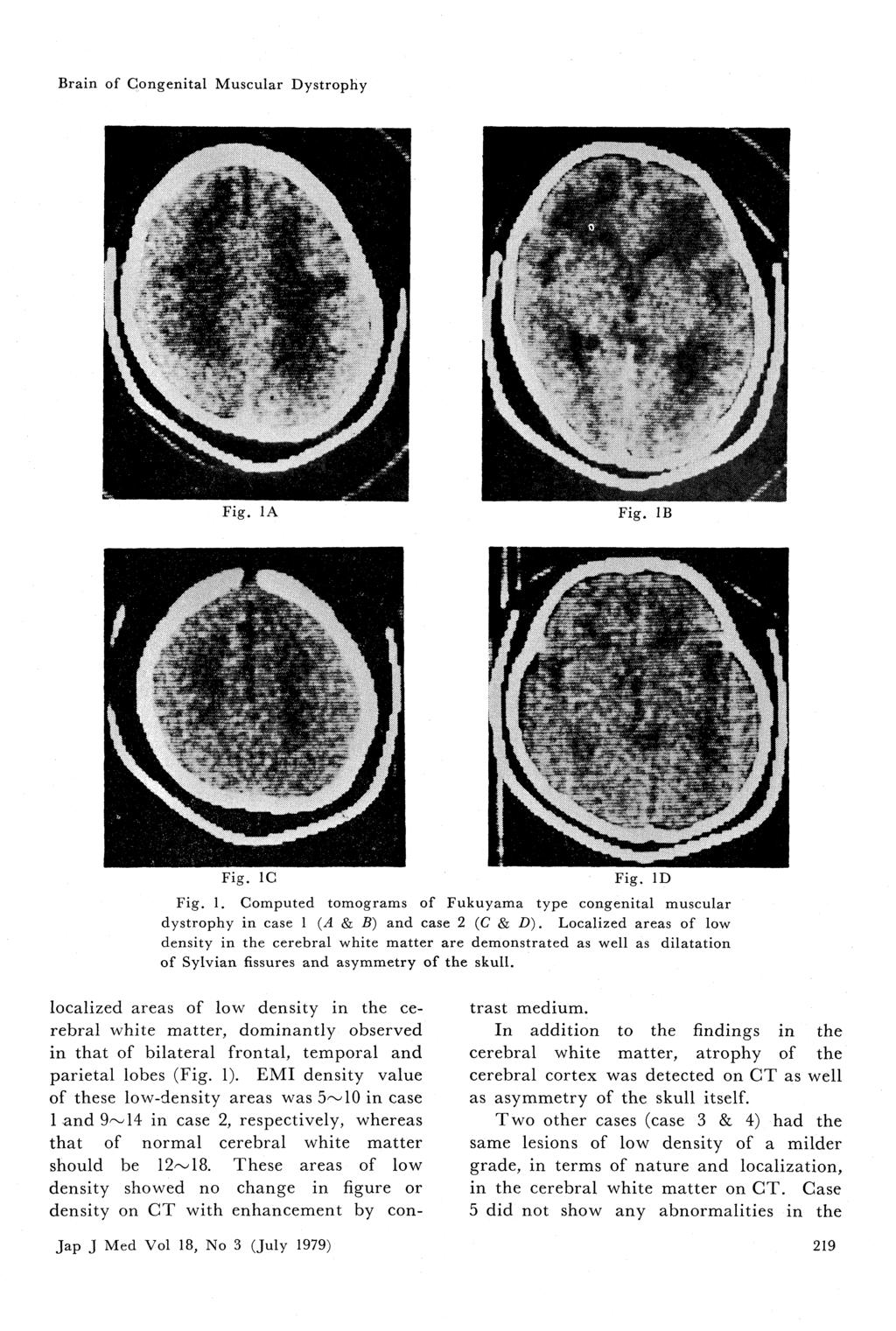 Brain of Congenital Muscular Dystrophy Fig. 1A Fig. IB Fig. 1G Fig. ID Fig. 1. Computed tomograms of Fukuyama type congenital muscular dystrophy in case 1 (A & B) and case 2 (C& D).