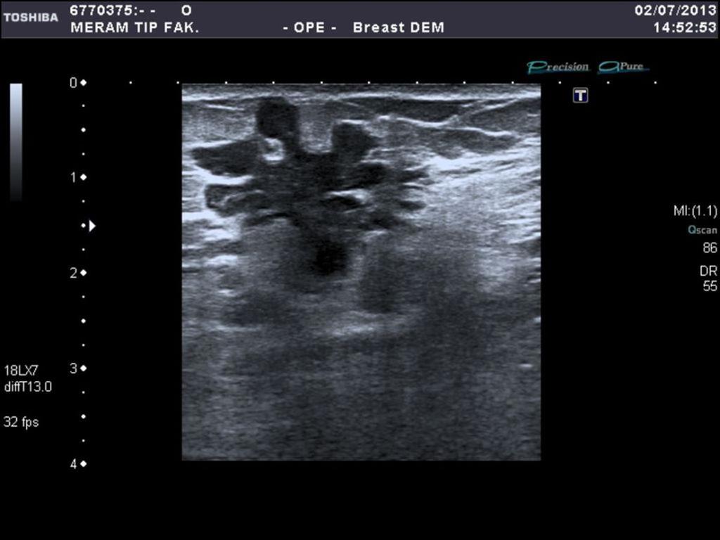 Fig. 1: B- mode US image of BIRADS 5 shapeless lesion with it's angular margins