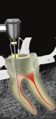 When this file reaches working length, the clinician may again accept the canal preparation or alternatively, if more deep shape is required, the canal can be enlarged thereafter with the use of the
