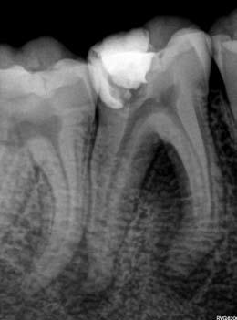 Gold Glider instrument. Root canal preparation was initiated by taking the WaveOne Gold Small 20/07 file, up to working length in all three root canals.
