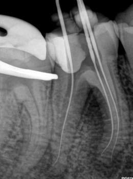Figure 9 depicts the post-operative result after obturation with the Calamus Dual Obturation System (Dentsply Sirona) using two Small and one Primary WaveOne Gutta Percha points (Dentsply Sirona) and