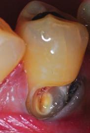 10 11 Figure 10: Mandibular left second premolar after caries removal on the bucco-gingival aspect the