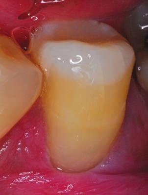 The canals were irrigated and obturated before the tooth was restored with SDR (Dentsply Sirona), a