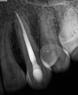 Case Report 6 The patient, a 47 year old female presented with pressure sensitivity on her maxillary left lateral incisor.