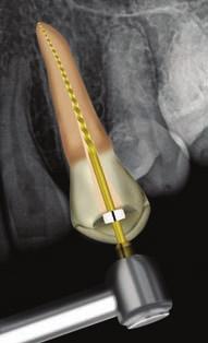 The post was ultrasonically loosened by means of vibration using a Start-X no. 3 ultrasonic tip (Dentsply Sirona).