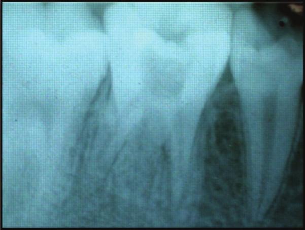 2 Case Reports in Dentistry Figure 1: Preoperative IOPA of 36. number 35 Ni-Ti rotary instruments in a crown down fashion till the working length. All the canals were irrigated with 2.
