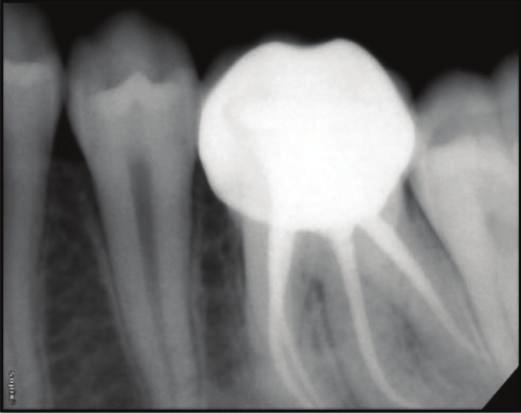 4 Case Reports in Dentistry Figure8:PostoperativeIOPAof36and46. The determination of root canal curvature is a key procedure for endodontic planning.