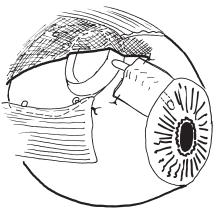 Step 10. Cont... Trabecular meshwork Microkeratome Ciliary body Dense opaque sclera over the scleral spur Slightly translucent tissue over the trabecular meshwork Step 11.