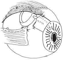 the needle enters the tissues Iris Anterior chamber Tube Fig. 10.3 The track of the needle through the tissues into the anterior chamber. Fig. 11.1 Inserting the tube into the needle track. Fig. 11.2 Feeding the tube down the needle track into the AC.