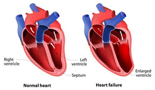 BMs of congestive heart failure (CHF) CHF occurs when infracted heart muscle can not pump blood efficiently Resulting in organs receiving depleted blood