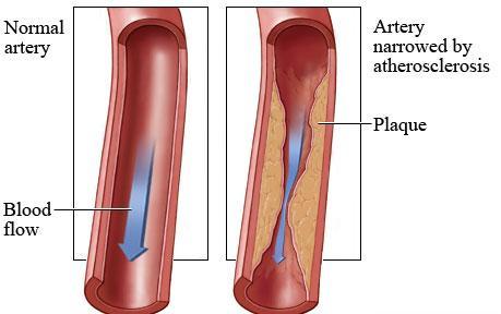 Atherosclerosis Characterized by deposition of fatty (mainly cholesterol)