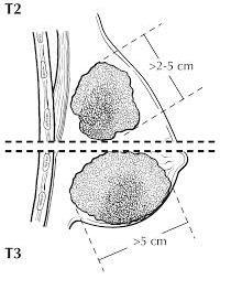 T-CATEGORIES: SIZE Example: Breast T1 20 mm T2 >20