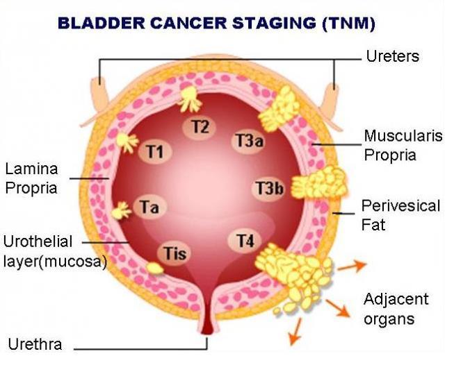 T-CATEGORIES: DEPTH OF INVASION Example: Bladder T1 subepithelial